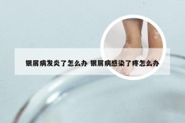 银屑病发炎了怎么办 银屑病感染了疼怎么办