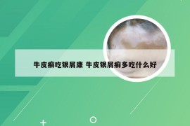 牛皮癣吃银屑康 牛皮银屑癣多吃什么好