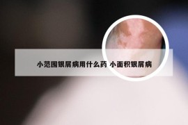 小范围银屑病用什么药 小面积银屑病