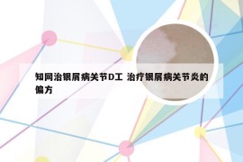 知网治银屑病关节D工 治疗银屑病关节炎的偏方