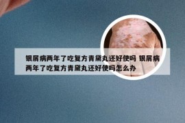 银屑病两年了吃复方青黛丸还好使吗 银屑病两年了吃复方青黛丸还好使吗怎么办