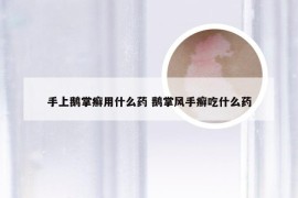 手上鹅掌癣用什么药 鹅掌风手癣吃什么药