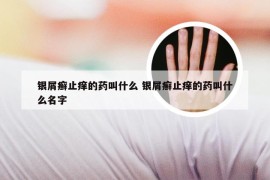 银屑癣止痒的药叫什么 银屑癣止痒的药叫什么名字