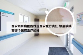 西安银屑病医院找选西安北方责任 银屑病陕西哪个医院治疗的好