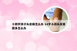 十四岁孩子头皮癣怎么办 14岁小孩头皮屑很多怎么办