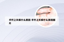 手杆上长癣什么原因 手杆上长癣什么原因图片