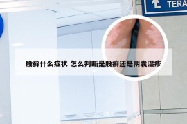 股藓什么症状 怎么判断是股癣还是阴囊湿疹