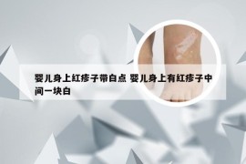 婴儿身上红疹子带白点 婴儿身上有红疹子中间一块白