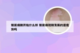 银屑病刚开始什么样 银屑病初期发展的速度快吗