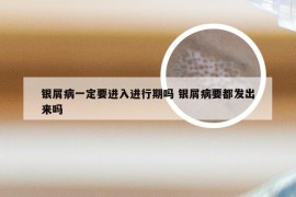 银屑病一定要进入进行期吗 银屑病要都发出来吗