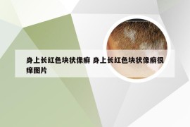 身上长红色块状像癣 身上长红色块状像癣很痒图片