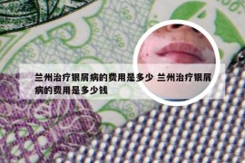 兰州治疗银屑病的费用是多少 兰州治疗银屑病的费用是多少钱