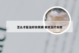 怎么才能治好白斑病 有效治疗白斑