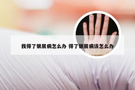 我得了银屑病怎么办 得了银屑病该怎么办