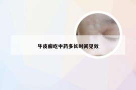 牛皮癣吃中药多长时间见效