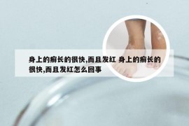 身上的癣长的很快,而且发红 身上的癣长的很快,而且发红怎么回事