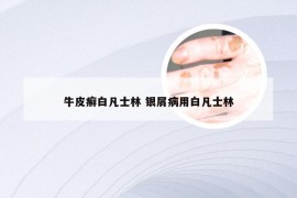 牛皮癣白凡士林 银屑病用白凡士林