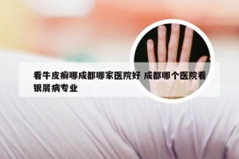 看牛皮癣哪成都哪家医院好 成都哪个医院看银屑病专业