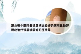 湖北哪个医院看银屑病比较好的医院比较好 湖北治疗银屑病最好的医院是