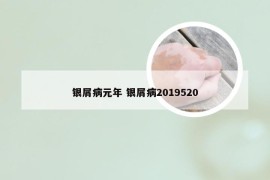 银屑病元年 银屑病2019520