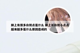 脚上有很多白斑点是什么 脚上长白斑小点点越来越多是什么原因造成的