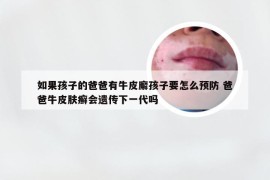 如果孩子的爸爸有牛皮廨孩子要怎么预防 爸爸牛皮肤癣会遗传下一代吗