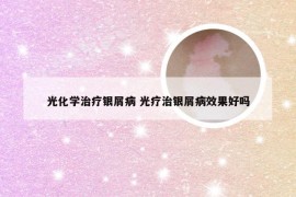 光化学治疗银屑病 光疗治银屑病效果好吗