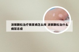 消银颗粒治疗银屑病怎么样 消银颗粒治什么病禁忌症