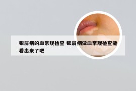 银屑病的血常规检查 银屑病做血常规检查能看出来了吧