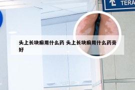 头上长块癣用什么药 头上长块癣用什么药膏好