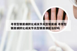 寻常型银屑病转化成关节炎型银屑病 寻常型银屑病转化成关节炎型银屑病能治好吗