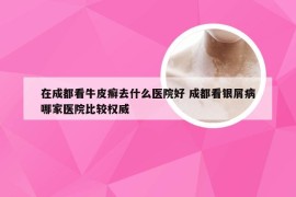 在成都看牛皮癣去什么医院好 成都看银屑病哪家医院比较权威