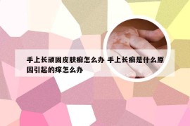 手上长顽固皮肤癣怎么办 手上长癣是什么原因引起的痒怎么办