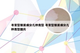 寻常型银屑病分几种类型 寻常型银屑病分几种类型图片