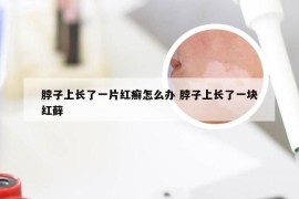 脖子上长了一片红癣怎么办 脖子上长了一块红藓