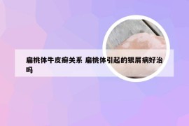 扁桃体牛皮癣关系 扁桃体引起的银屑病好治吗