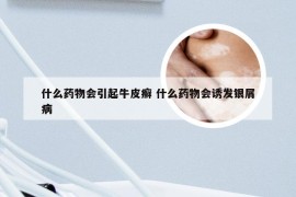 什么药物会引起牛皮癣 什么药物会诱发银屑病