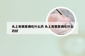 头上有银屑病吃什么药 头上有银屑病吃什么药好