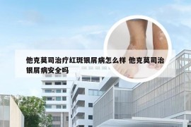 他克莫司治疗红斑银屑病怎么样 他克莫司治银屑病安全吗