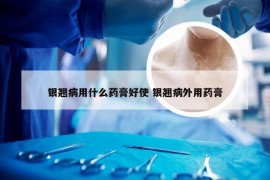 银翘病用什么药膏好使 银翘病外用药膏