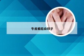 牛皮癣后白印子