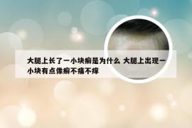 大腿上长了一小块癣是为什么 大腿上出现一小块有点像癣不痛不痒