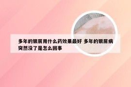 多年的银屑用什么药效果最好 多年的银屑病突然没了是怎么回事