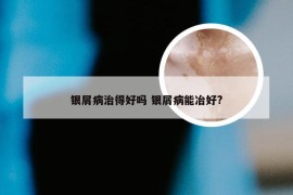 银屑病治得好吗 银屑病能冶好?