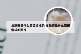 皮肤藓是什么原因造成的 皮肤藓是什么原因造成的图片