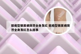 脓疱型银屑病突然全身发红 脓疱型银屑病突然全身发红怎么回事