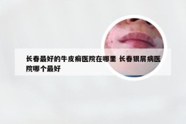 长春最好的牛皮癣医院在哪里 长春银屑病医院哪个最好