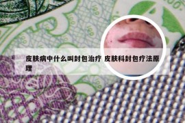 皮肤病中什么叫封包治疗 皮肤科封包疗法原理