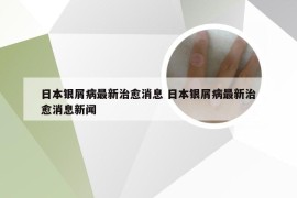 日本银屑病最新治愈消息 日本银屑病最新治愈消息新闻