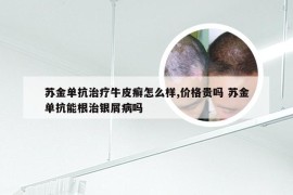 苏金单抗治疗牛皮癣怎么样,价格贵吗 苏金单抗能根治银屑病吗